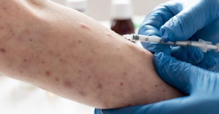 Exame detecta nova variante da Mpox: SP soma 62 casos e região entra em alerta